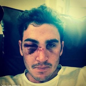 باؤنسر کی ضرب سے کیزویٹر کی ناک اور گال کی ہڈی ٹوٹ گئی جبکہ آنکھ سوج چکی ہے (تصویر: Twitter/Craig Kieswetter) 